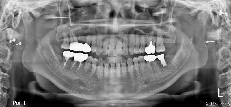 만성복합치주염으로 발치 후 뼈이식을 한 사례!대화임플란트치과의원 만성복합치주염으로 발치 후 뼈이식을 한 사례!대화임플란트치과의원