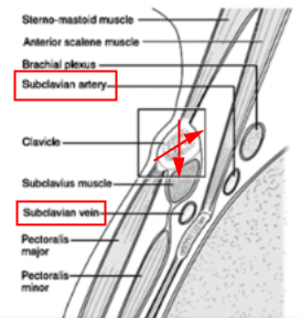 [정형외과 전문의] 쇄골 골절의 치료 (Fracture of clavicle shaft, proximal clavicle ...