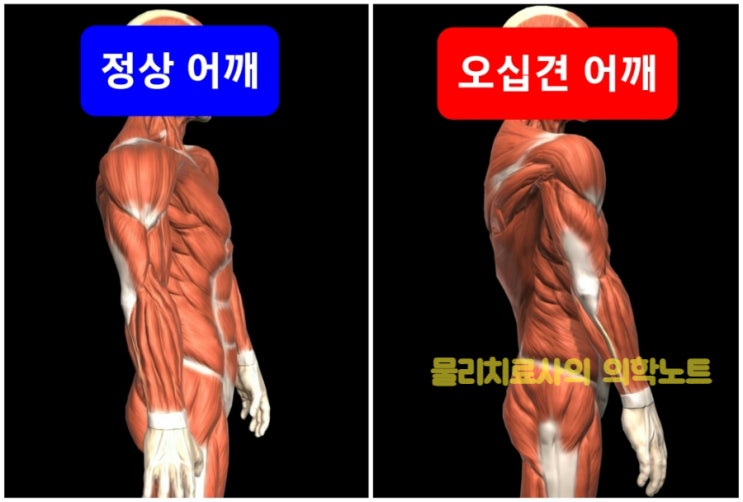  오십견(동결견, Frozen shoulder)과 손저림, 소흉근 단축의 관계