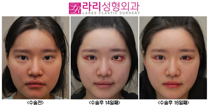 라리성형외과] 눈꼬리내리기수술 후 결막부종에 관하여.. (원인과 대처) : 네이버 블로그