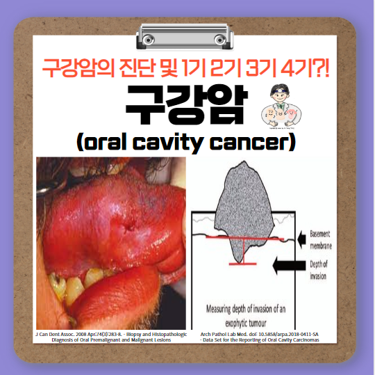  구강암(oral cavity cancer) (2) - 진단, 병기