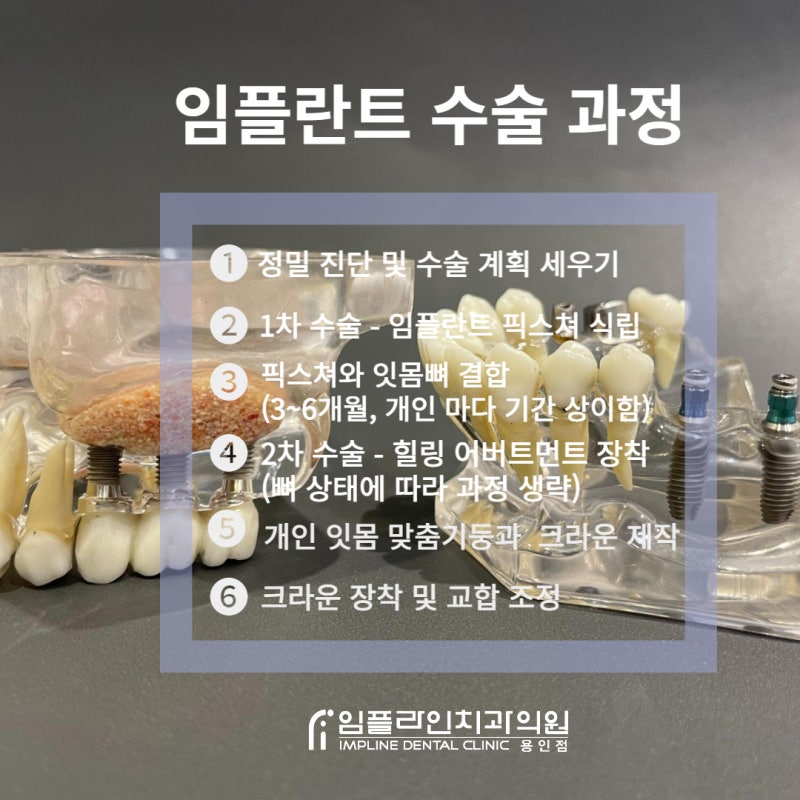 용인치과/처인치과 새해에는 보험 임플란트 심고 맛있는거 실컷 먹자!