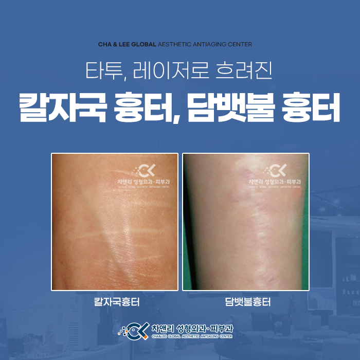  비자살성 자해 칼자국 흉터, 담뱃불흉터