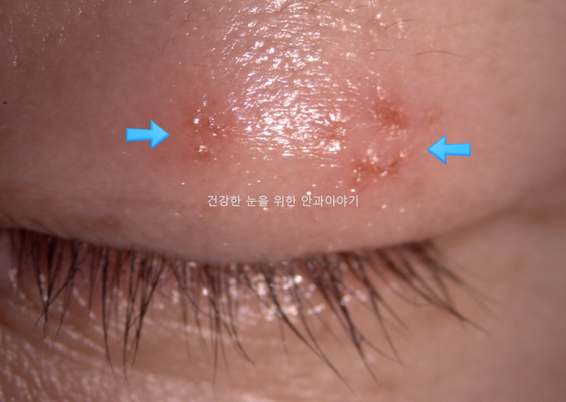 눈꺼풀에 물집이 났어요 - 헤르페스 안검염 원인 치료