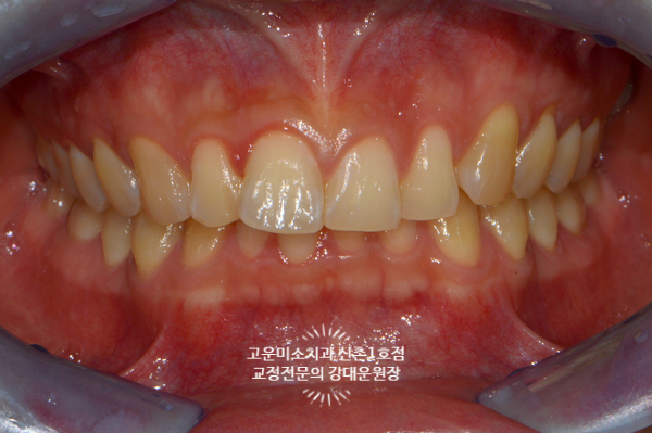  과개교합 윗니돌출 2급부정교합 비발치교정치료 비수술교정 신촌교정치과 고운미소신촌1호점 치료증례