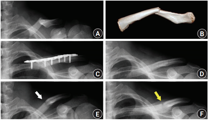 [정형외과 전문의] 쇄골 골절의 치료 (Fracture of clavicle shaft, proximal clavicle ...