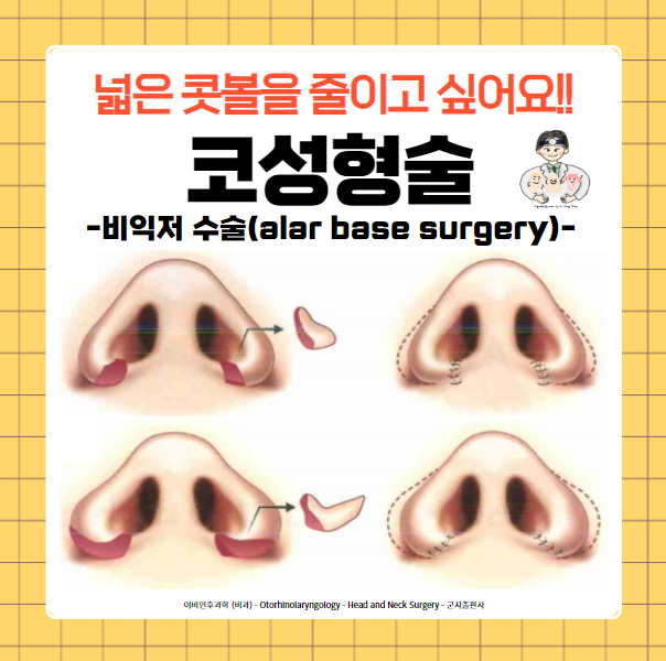  코성형술(Rhinoplasty) (6) - 콧볼축소수술(비익저수술, alar base surgery)