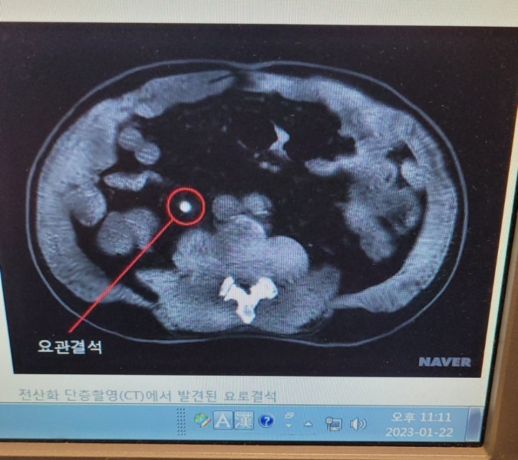  설날 응급 요로결석 으로 내원 증상 진통제 맞고 안아프다하셔서 다행. 체외충격파쇄석술 대기중