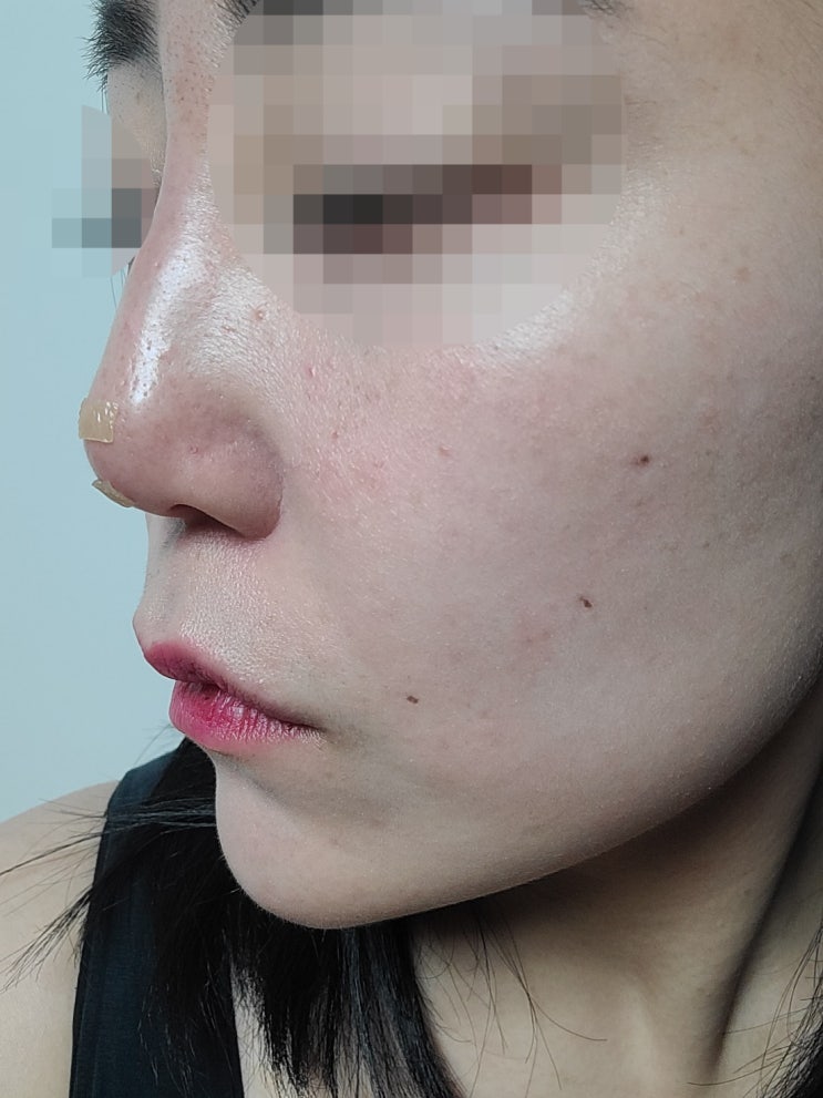  강남코필러잘하는곳 낮은코 작은코 하이코 코리프팅 후기