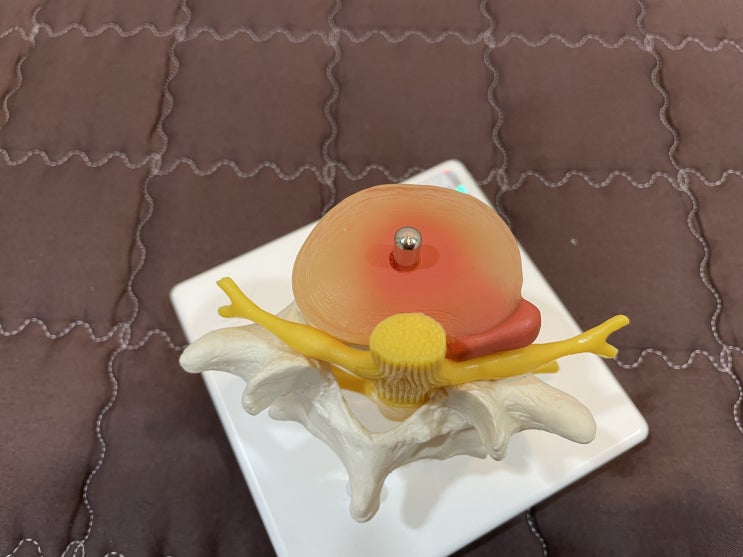  허리 통증 꼭 수술해야 하나요?