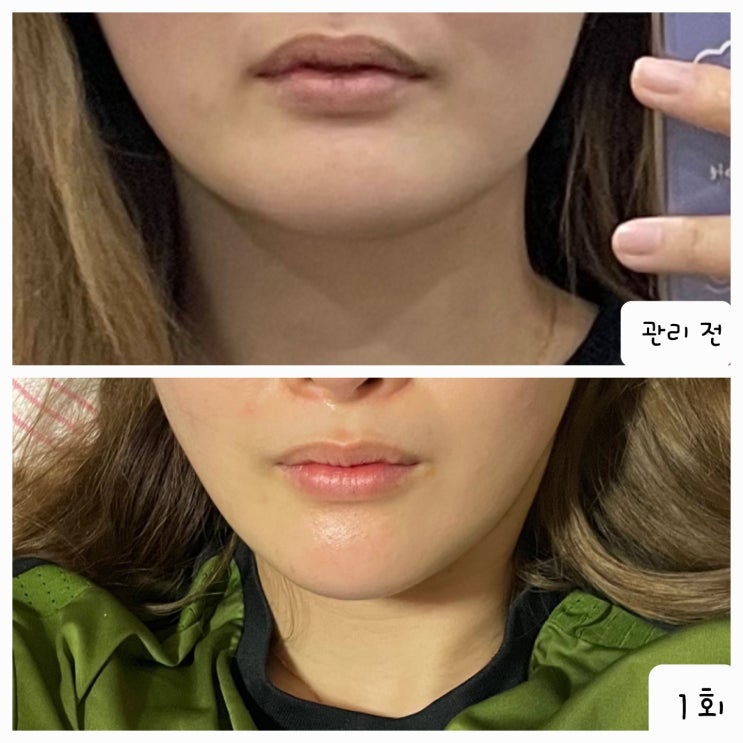  예비신부님이라면 무조건 받아야 하는 작은얼굴관리