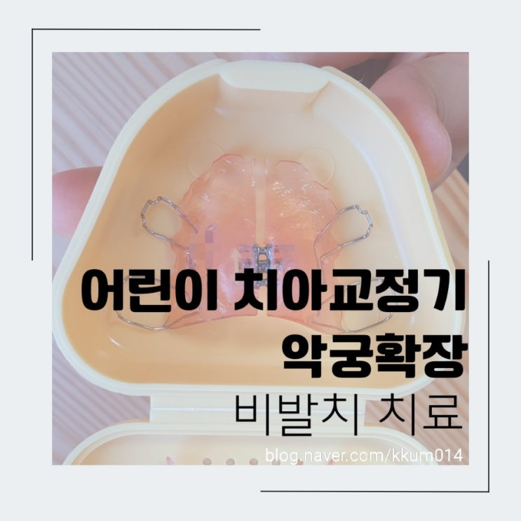  초등학생 치아교정기 어린이 악궁확장 비발치치료