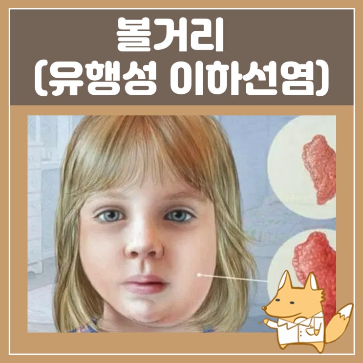  볼거리 치료 증상 전염 성인 유행성 이하선염 통증 : 귀뒤 턱밑 목에 멍울