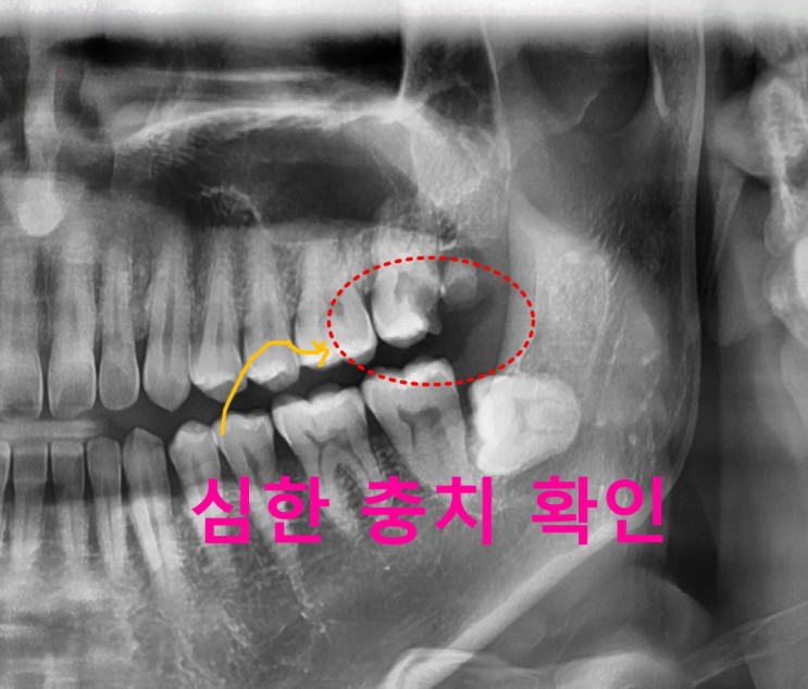 미사치과 입을 크게 벌려서 위쪽 어금니를 양치질하면 안되는 이유 - 치아 충치 치료 증례
