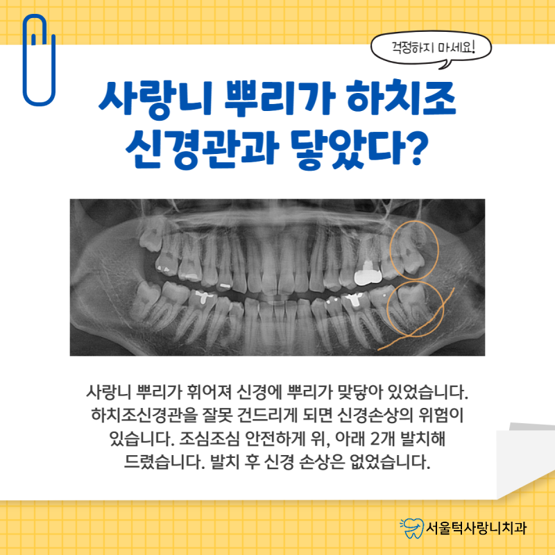 분당구치과 매부시 사랑니발치 안전하게 진행해드리겠습니다. 3