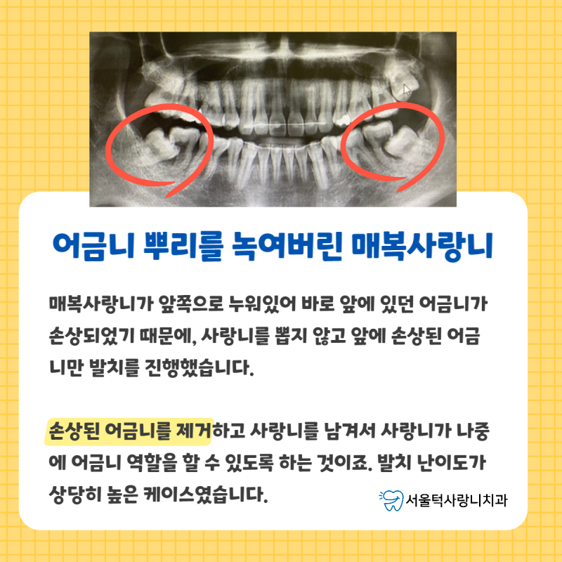 분당구치과 매부시 사랑니발치 안전하게 진행해드리겠습니다. 2