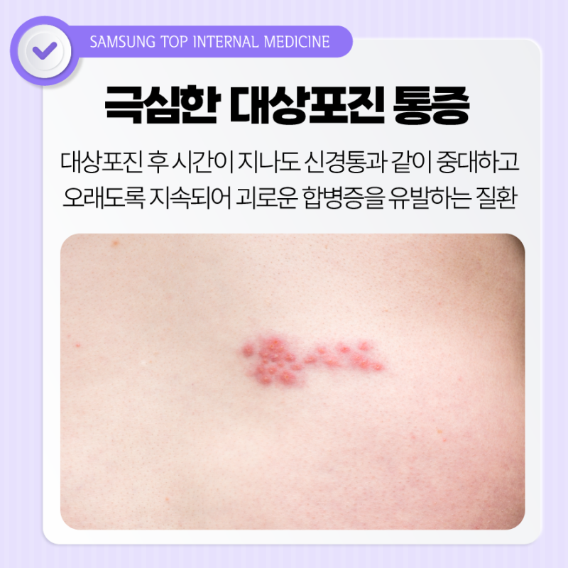 대상포진 예방접종의 모든것 초기증상