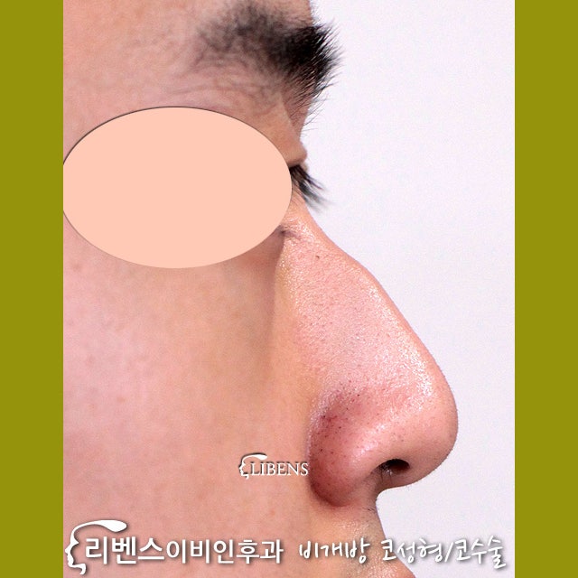 신사역코성형 비염 코수술 재발없이 5