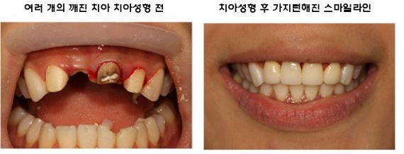  특허받은 매직키스치과만의  치아성형, 라미네이트로 아름다운 스마일라인 살리자