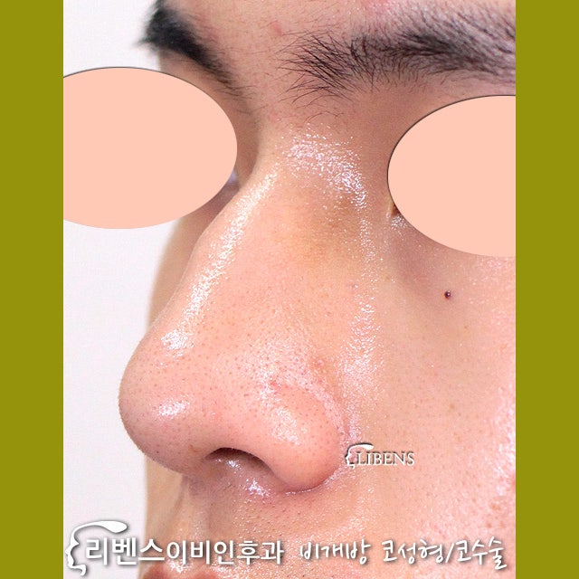 신사역코성형 비염 코수술 재발없이 4
