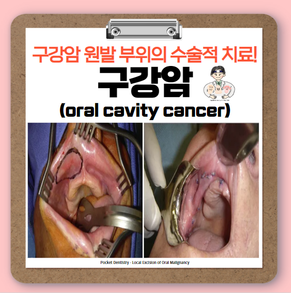  구강암(oral cavity cancer) (3) - 원발 부위의 수술적 치료