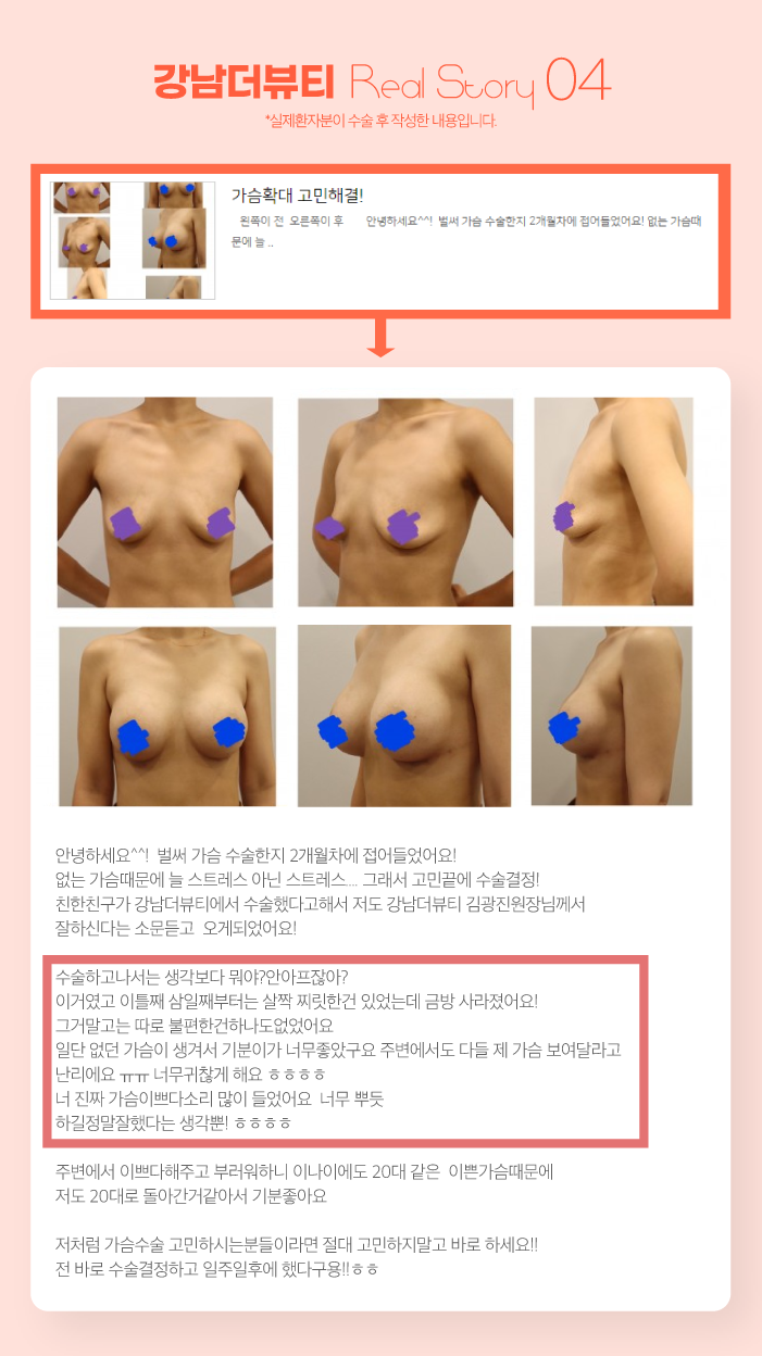 세종시성형외과 모유수유 가능한 가슴성형, 가격과 과정 알려드려요. : 네이버 블로그
