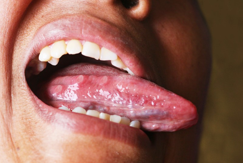 혀밑구내염 빨리 낫고 싶다면 어떻게? : 네이버 블로그