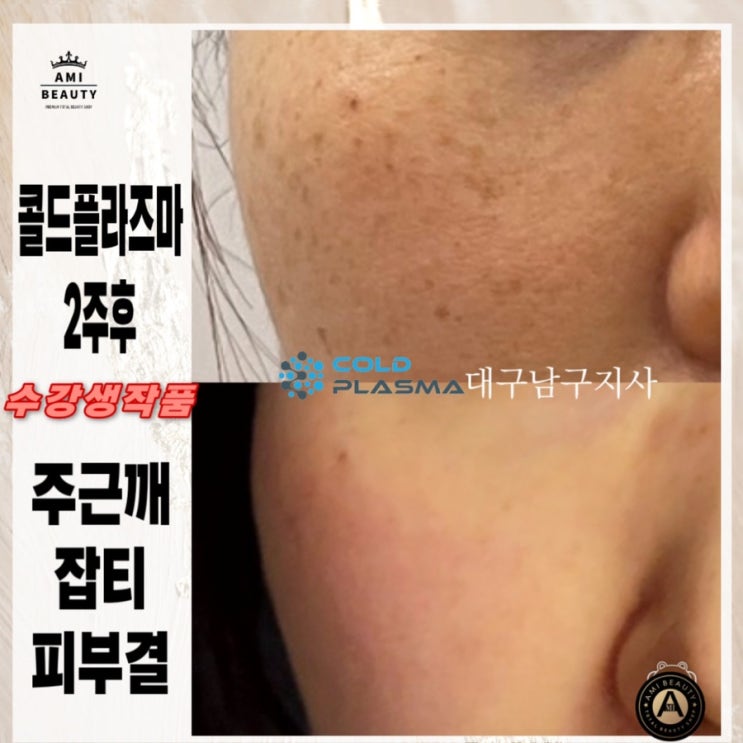  콜드플라즈마(주름.모공.흉터.여드름)수강은 대구 아미뷰티 아카데미에서 !!!