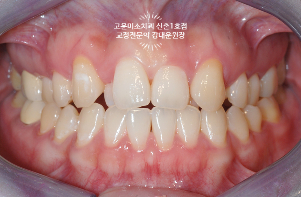  앞니반대교합 심한덧니 총생 비발치치료 신촌교정치과 고운미소신촌1호점 치료증례