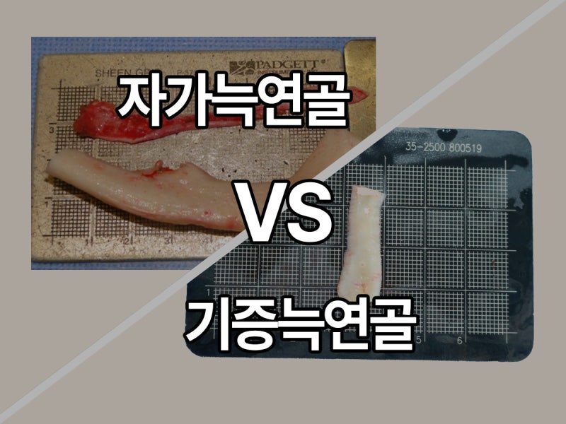 늑연골코수술 자가늑연골VS기증늑연골 비용,장점,단점? : 네이버 블로그 늑연골코수술 자가늑연골Vs기증늑연골 비용,장점,단점? : 네이버 블로그