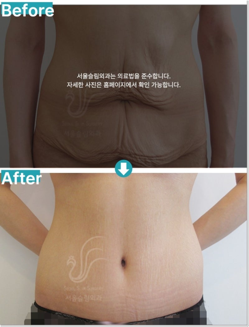 강남복벽이 탄탄해지고 리프팅!