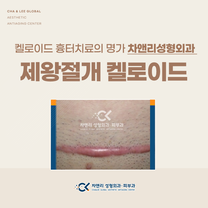  제왕절개 켈로이드주사 통증 줄이려면
