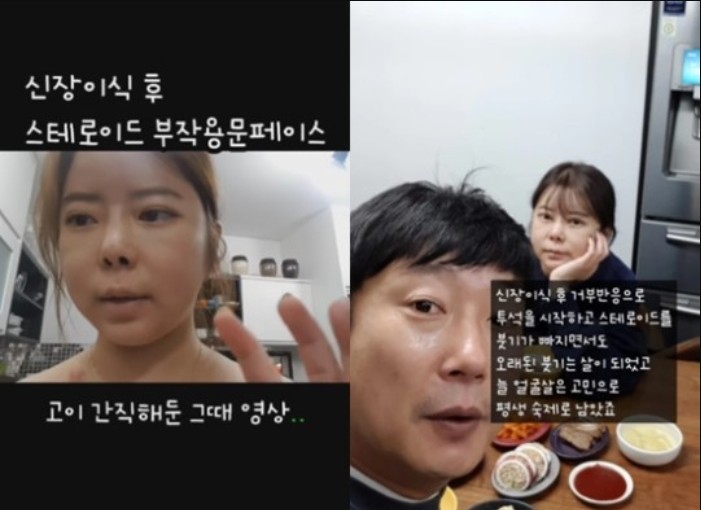  이수근 아내 박지연 스테로이드 부작용 문페이스 공개 언능 회복하시길 바래요