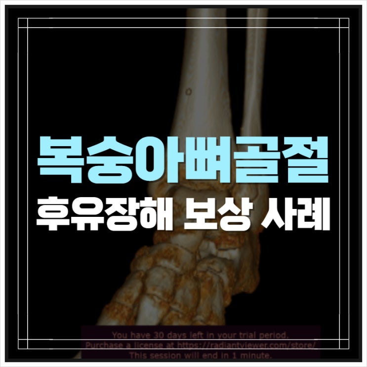 복숭아뼈골절 후유장해 보험금 손해사정 사례