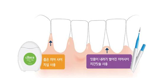  치실 꼭 써야하는 이유, 충치로 인해 앞니 깨짐