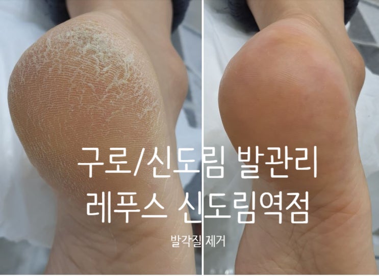  신도림발관리 레푸스 신도림역점 발각질제거 강추!