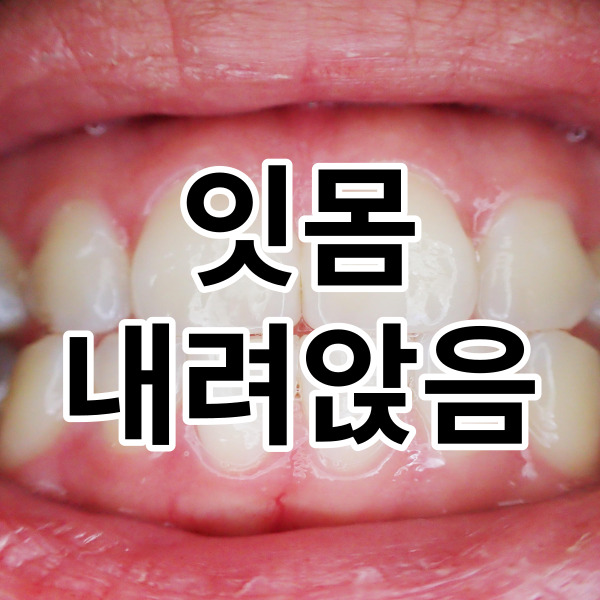 잇몸 내려앉음 어떻게 해결할까요?