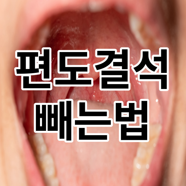  편도결석 빼는법 완벽하게 총정리!