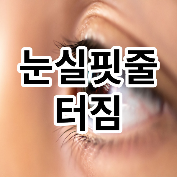  눈 실핏줄 터짐 이럴 땐 어떻게 해야 할까요?