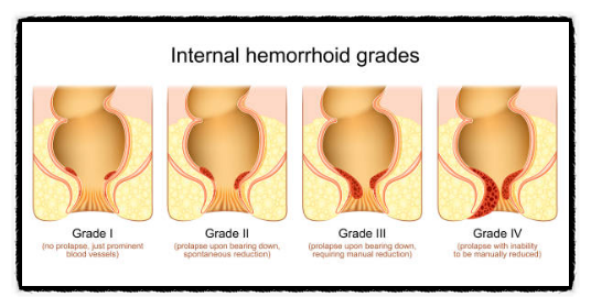 치질(hemorrhoids) 원인과 증상( 증세) 연고와 약을 알아보고 수술 이야기, 좋은 음식으로 예방