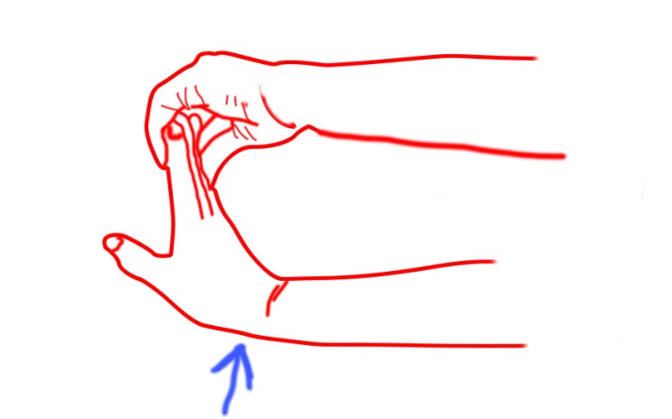 손목터널증후군 운동 완치방법