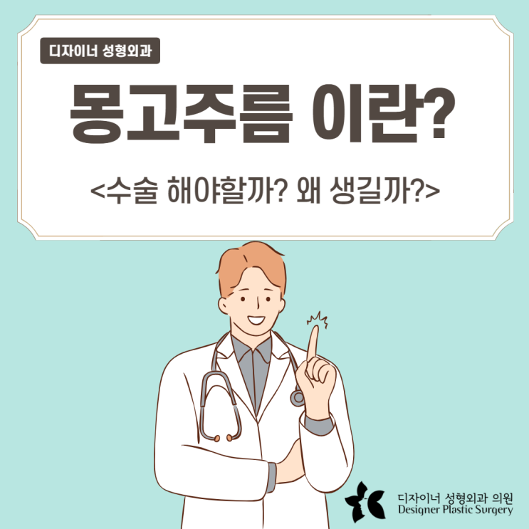  몽고주름이란? 왜생길까? 수술해야할까?