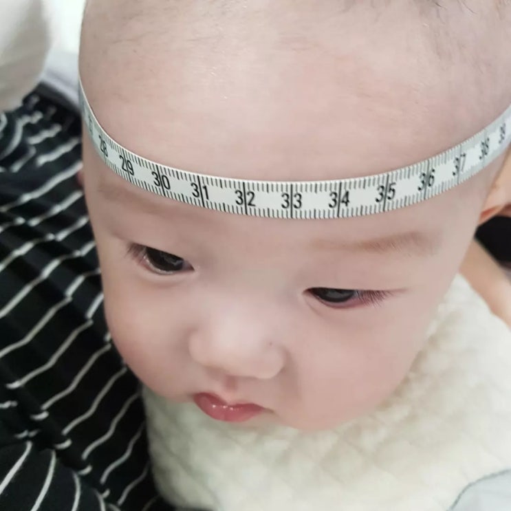  D+127 두상교정 상담!