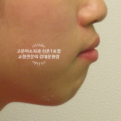  2급부정교합 돌출 뚱한 입술 발치교정치료 신촌교정치과 고운미소신촌1호점 치료증례