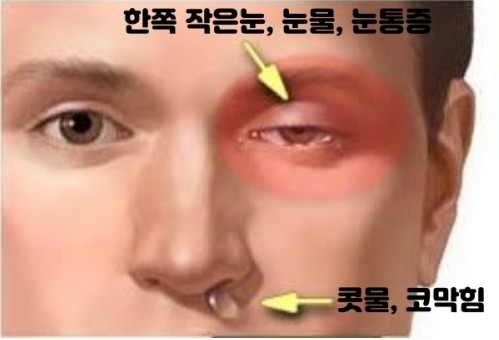 눈통증(왼쪽 오른쪽, 미간, 눈썹뼈, 안구) 두통 왜 한꺼번에? : 네이버 블로그
