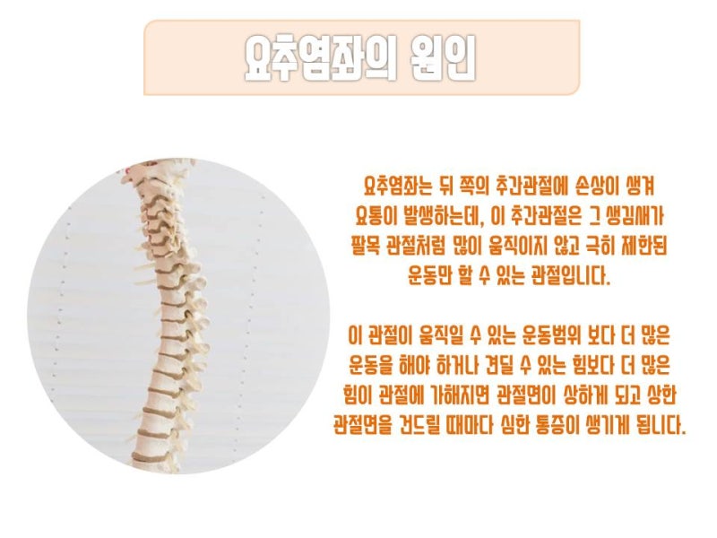 광주허리병원) 갑작스러운 요통 급성 요추염좌란?