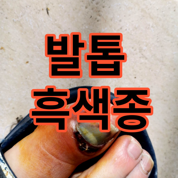  발톱 흑색종, 혹시 나도 걸린 건가?