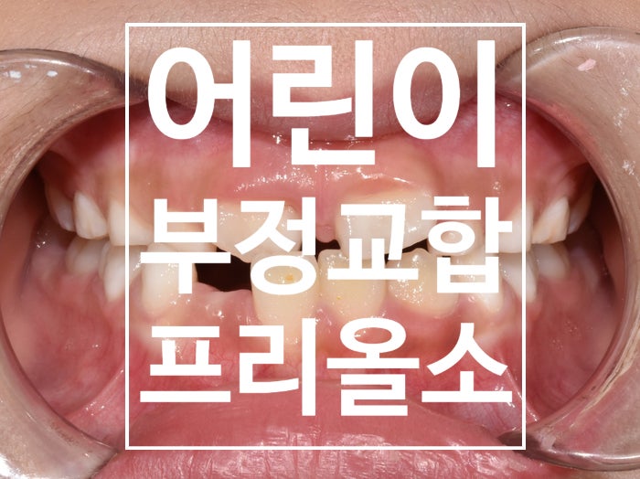 어린이 부정교합, 반대교합을 치료하기 위한 프리올소(근기능장치)