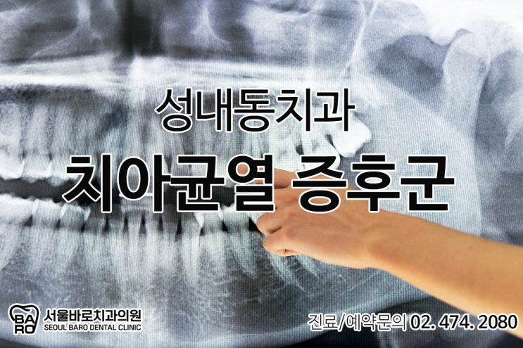  치아에 균열이 생겼다면, 성내동 치과와 상의하세요.