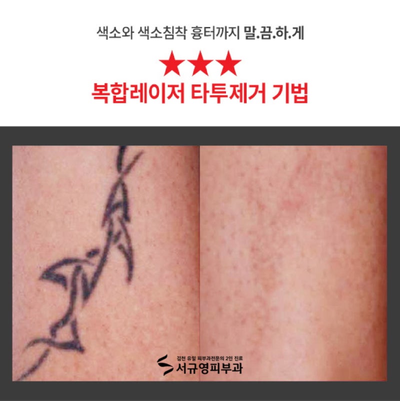 구미계피부과_문신제거, 문신레이저 마이크로레이저 그리고 이것! 2